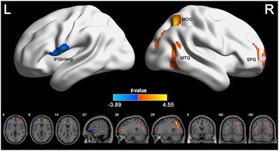 Corrigendum: Alterations of cerebral perfusion and functional connectivity in children with idiopathic generalized epilepsy